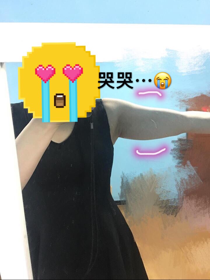 【雷射減脂】手臂不瘦，穿什麼都很顯胖！對付我的手臂贅肉!