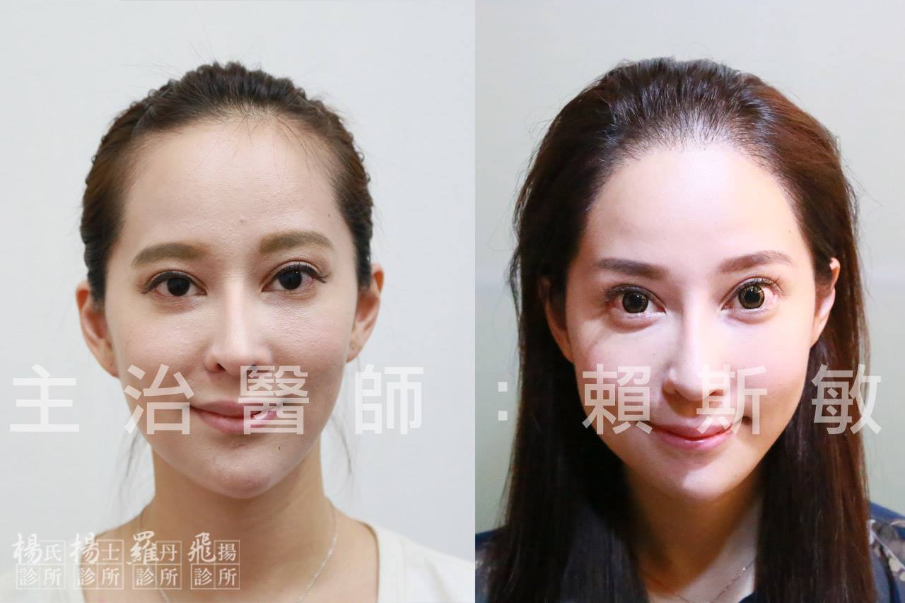 女孩解決「髮際線過高」的煩惱！