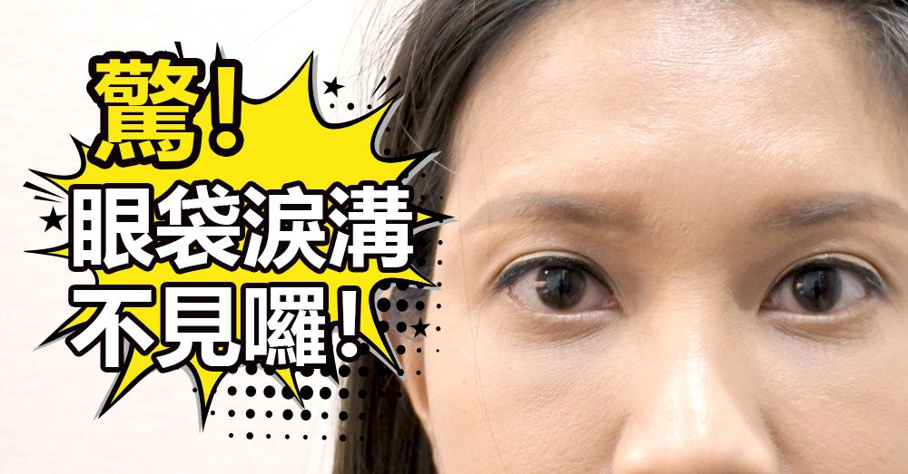 【新竹‧眼袋淚溝手術】終結惱人黑眼圈！術後三個月心得分享