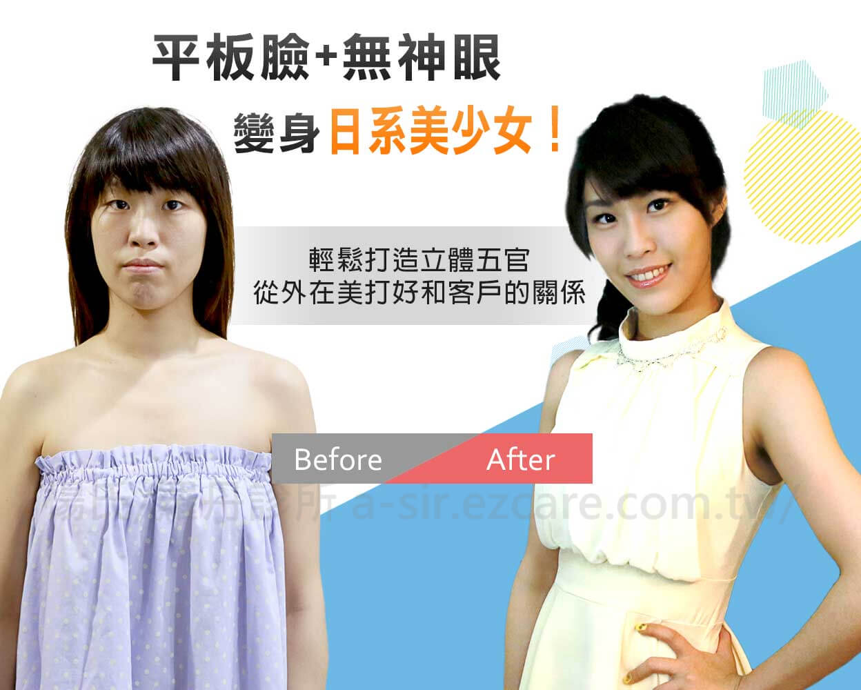 【醫美微整形】整形節目大改造 晶亮雙眼皮個案-瑋瑋