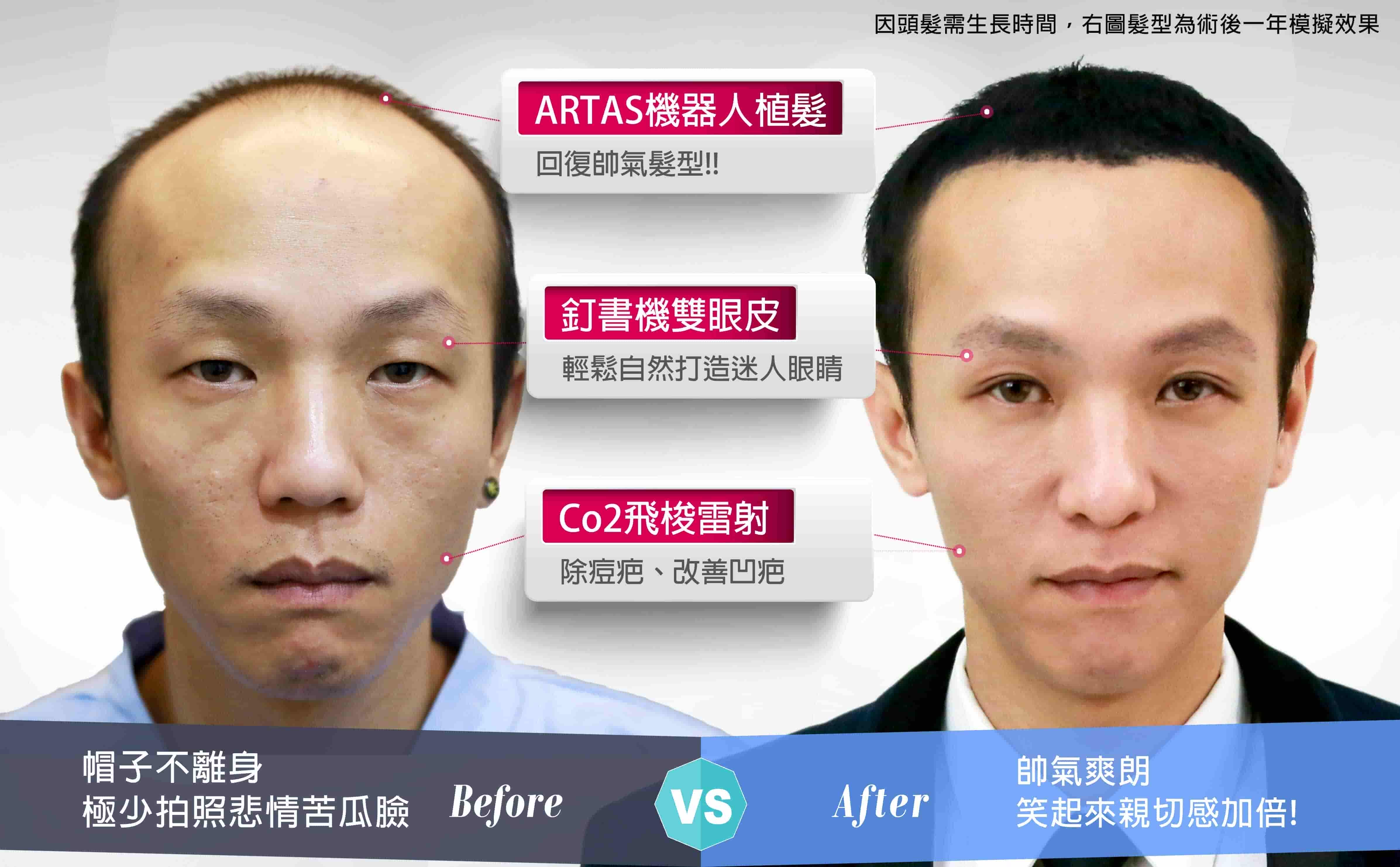 【醫美微整形】節目-實在不可思議大改造-個案No.6知秋