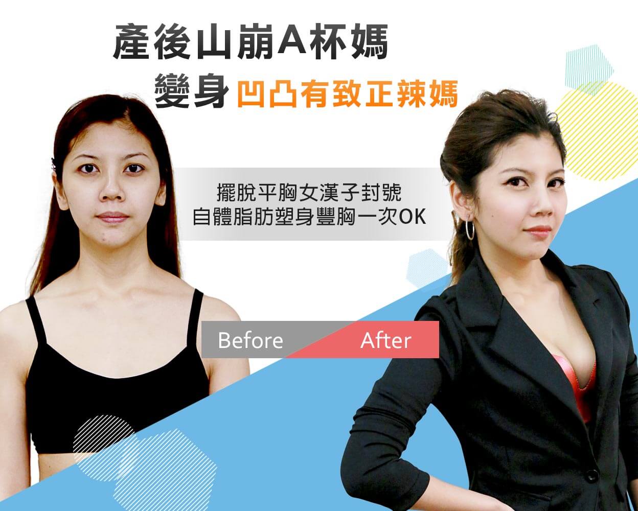 產後正媽的自體脂肪豐胸隆乳