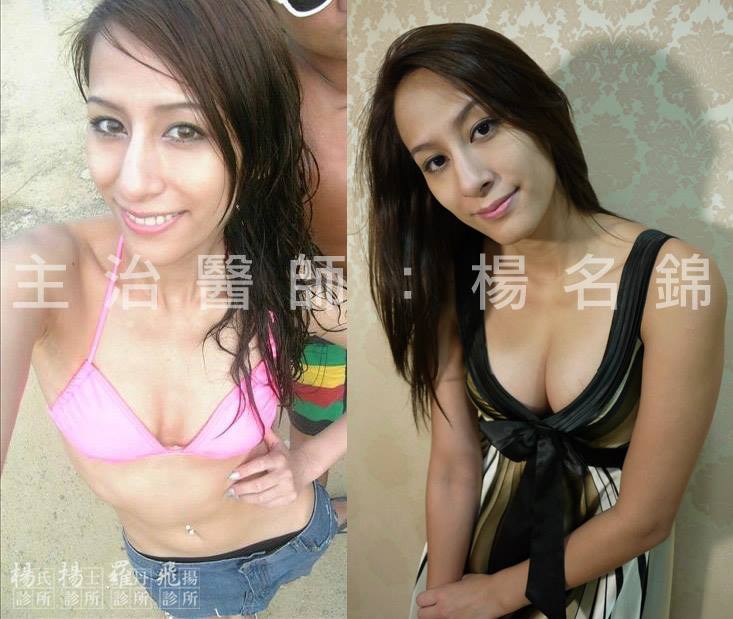 小Janet Gina自體脂肪隆乳實紀