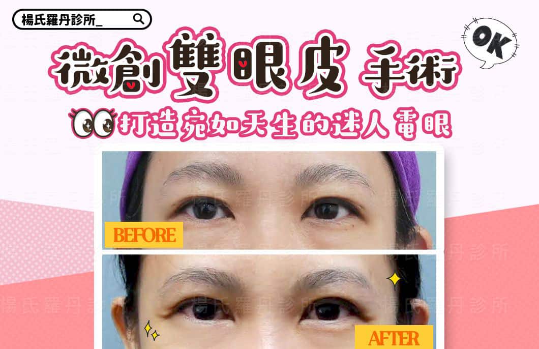 【雙眼皮】微創雙眼皮手術，打造宛如天生的迷人電眼！