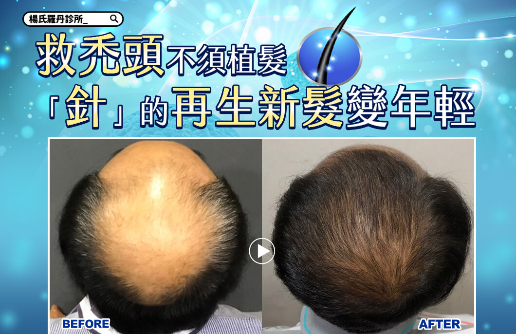 【複合式生髮】救禿頭不須植髮，「針」的再生新髮變年輕