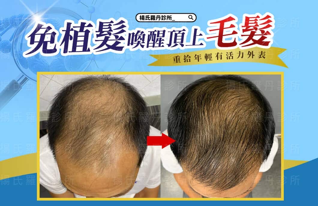 【複合式泌髮】免植髮喚醒頂上毛髮，重拾年輕有活力外表