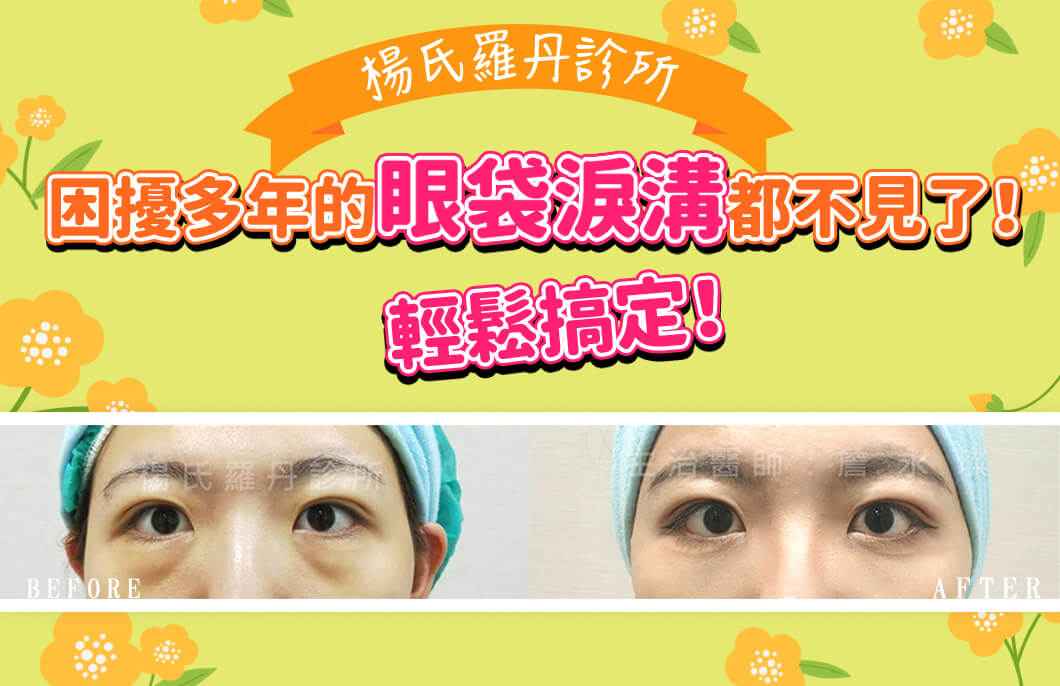 【眼袋淚溝】困擾多年的眼袋淚溝都不見了！輕鬆搞定！