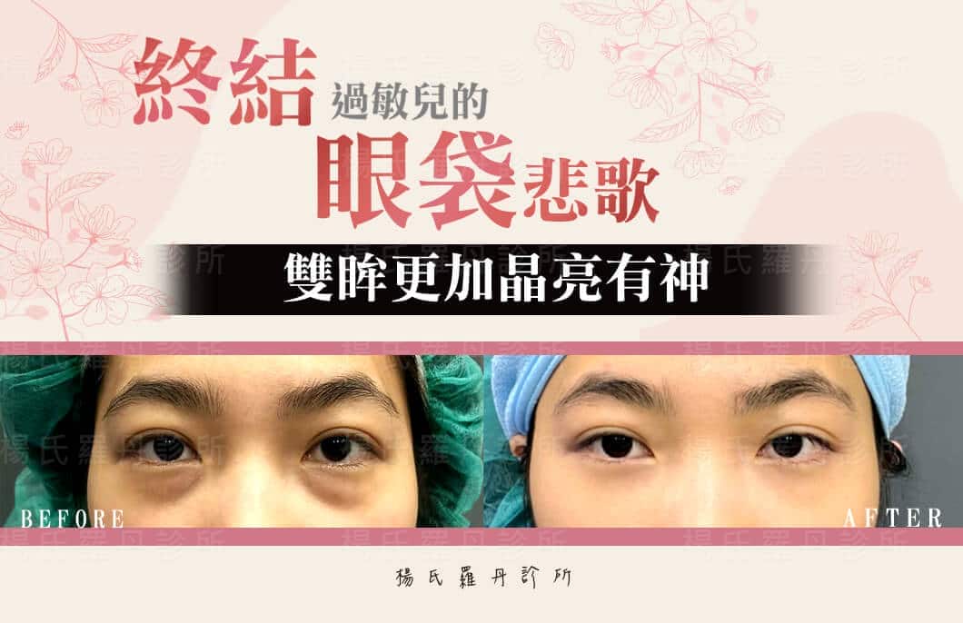【眼袋淚溝】終結過敏兒的眼袋悲歌，雙眸更加晶亮有神