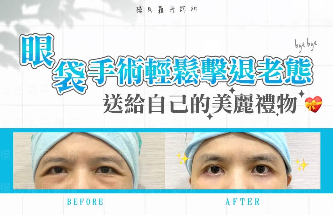 【眼袋淚溝】眼袋手術輕鬆擊退老態，送給自己的美麗禮物
