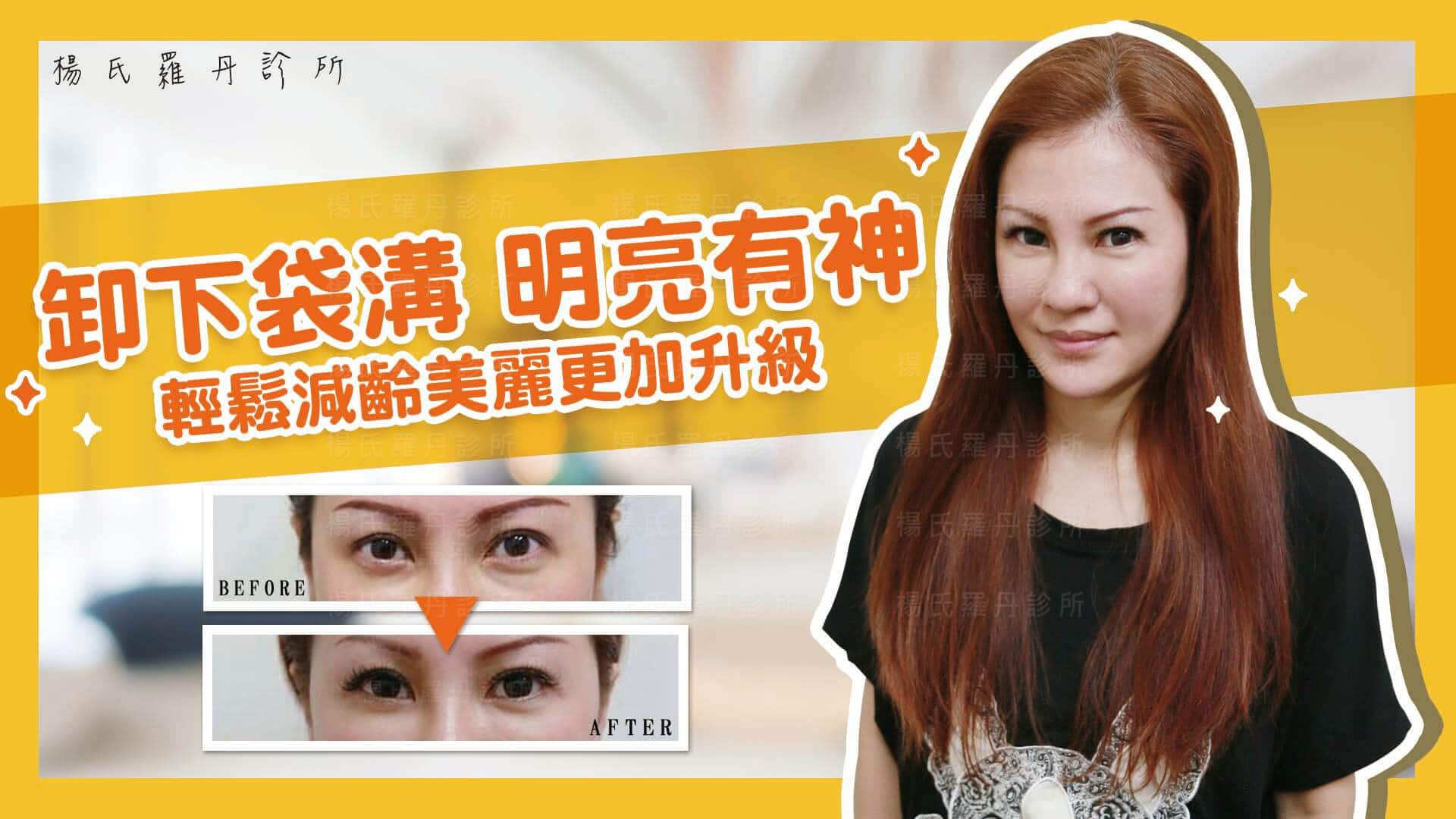 【眼袋淚溝】卸下袋溝明亮有神，輕鬆減齡美麗更加升級