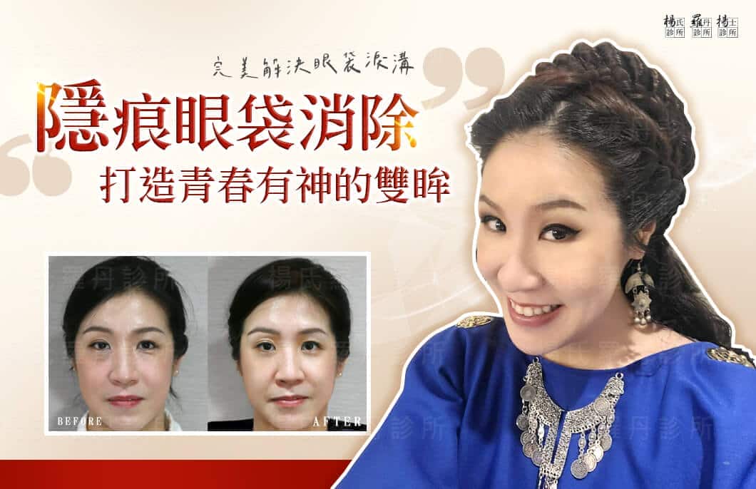 【眼袋淚溝】隱痕眼袋消除術，保持表演藝術家的靈魂和亮眼外形！