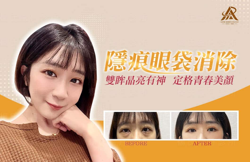 【眼袋淚溝】朵莫的隱痕眼袋消除，雙眸晶亮有神，定格青春美顏！