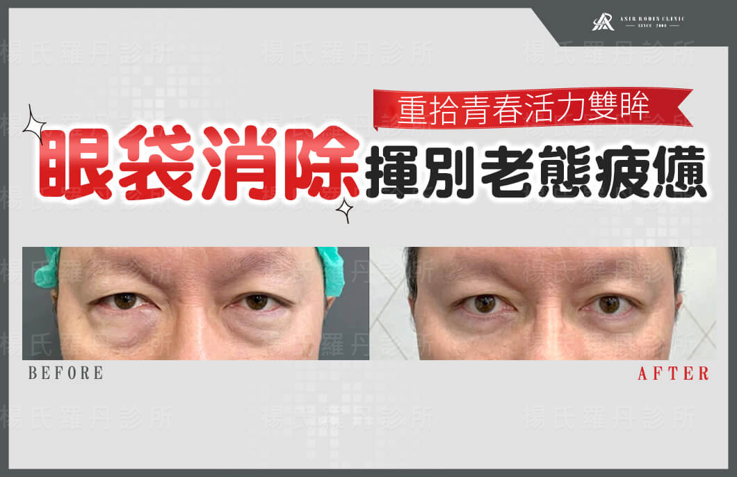 【眼袋淚溝】眼袋消除揮別老態疲憊，重拾青春活力雙眸