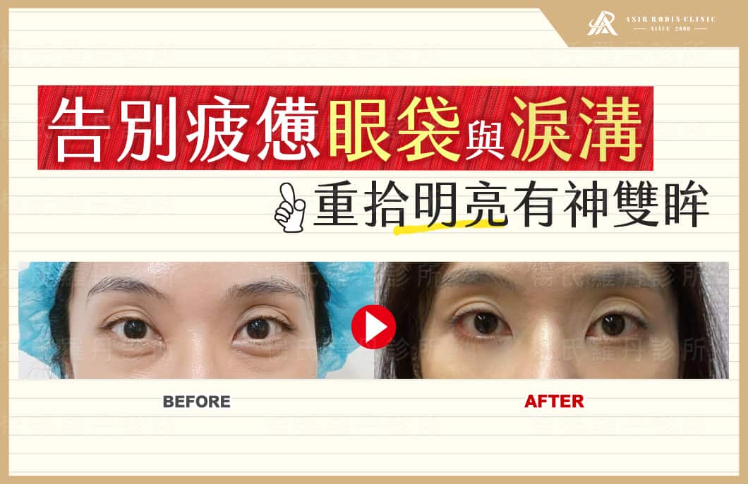 【眼袋淚溝】告別疲憊眼袋與淚溝，重拾明亮有神雙眸！