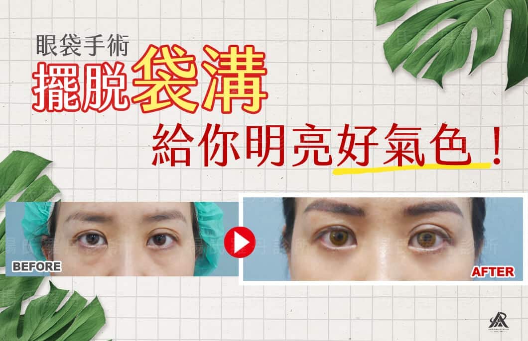 【眼袋淚溝】眼袋手術擺脫「袋溝」，給你明亮好氣色！
