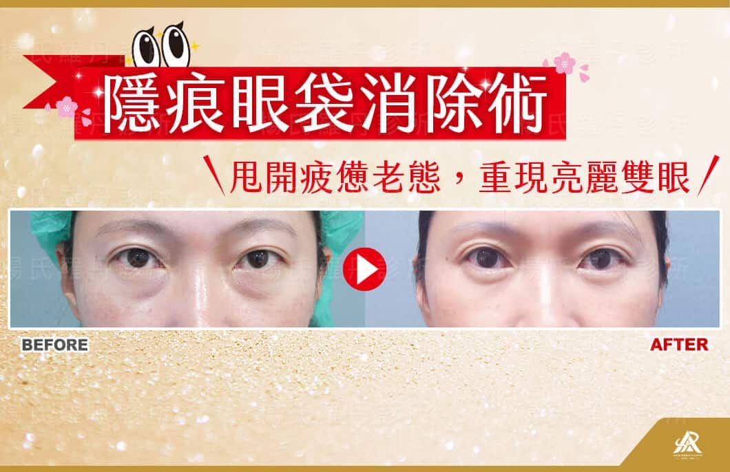 【眼袋淚溝】隱痕眼袋消除術，甩開疲憊老態，重現亮麗雙眼