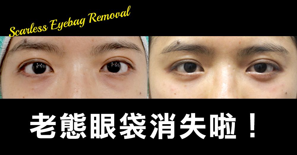 【眼袋淚溝】超隱痕眼袋淚溝手術  和惱人眼袋說掰掰！