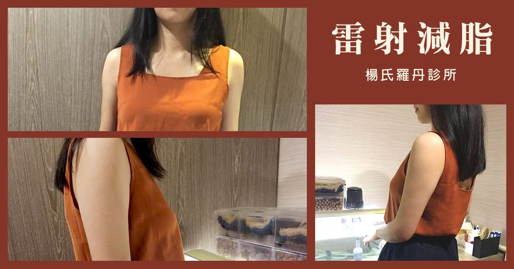【雷射減脂】偷偷做了手臂雷射減脂 術後三個月心得分享