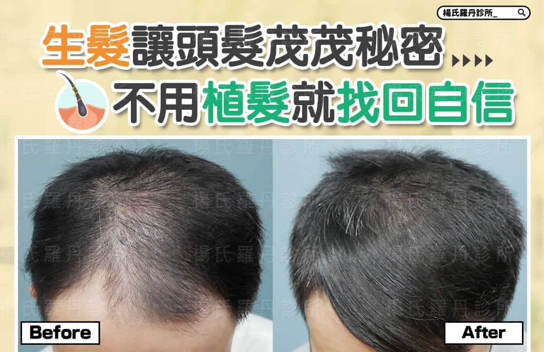 【複合式生髮】生髮讓頭髮茂茂密密，不用植髮就找回自信