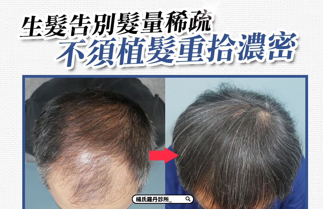 【複合式生髮】生髮告別髮量稀疏，不須植髮重拾濃密！