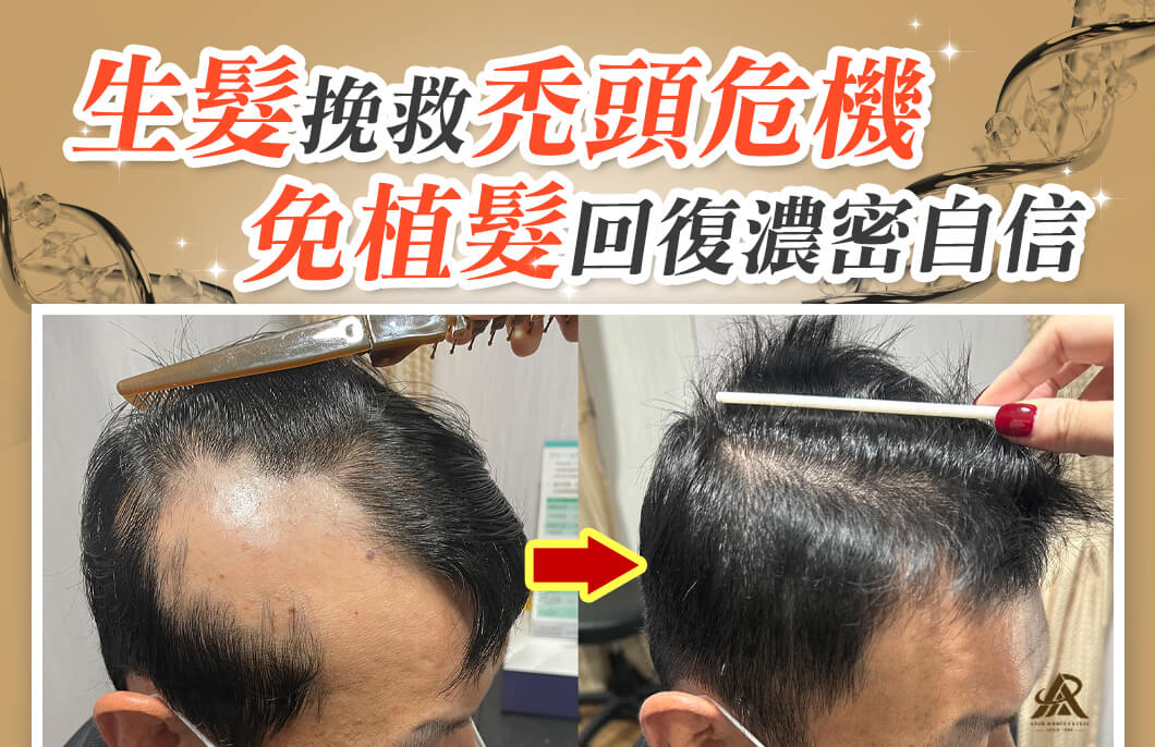 【複合式生髮】生髮挽救禿頭危機，免植髮回復濃密自信