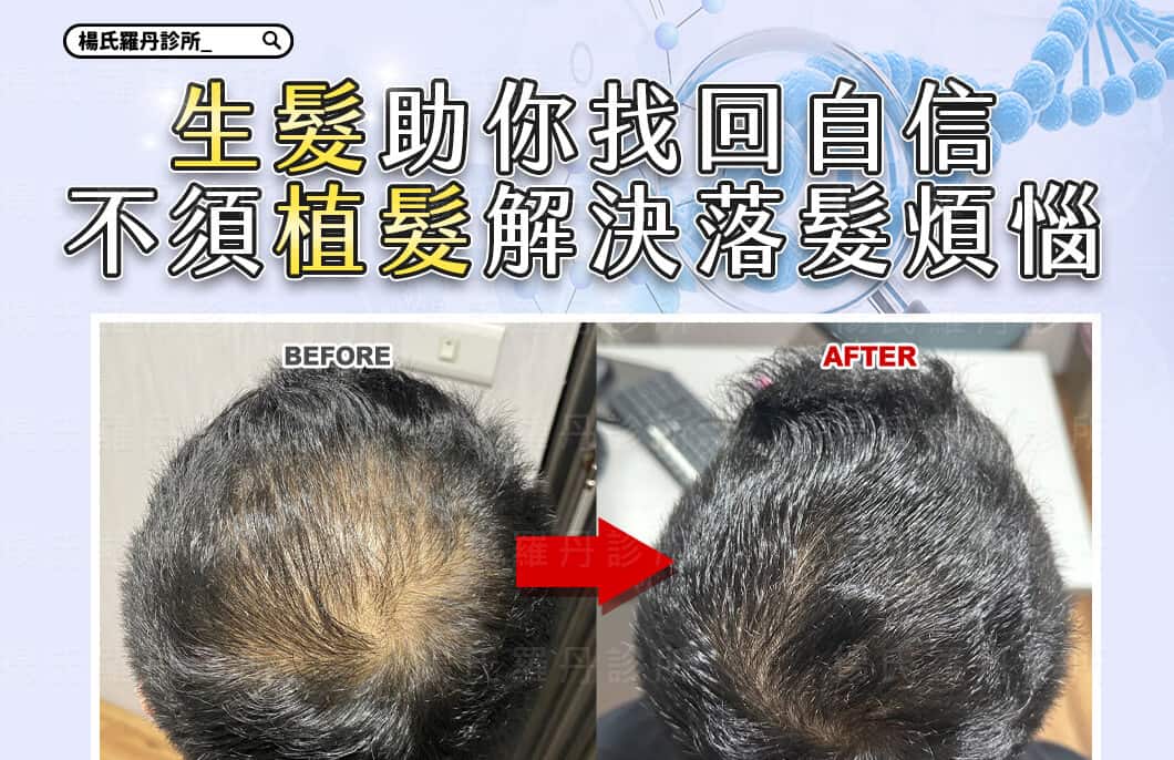 【複合式生髮】生髮助你找回自信，不須植髮解決落髮煩惱