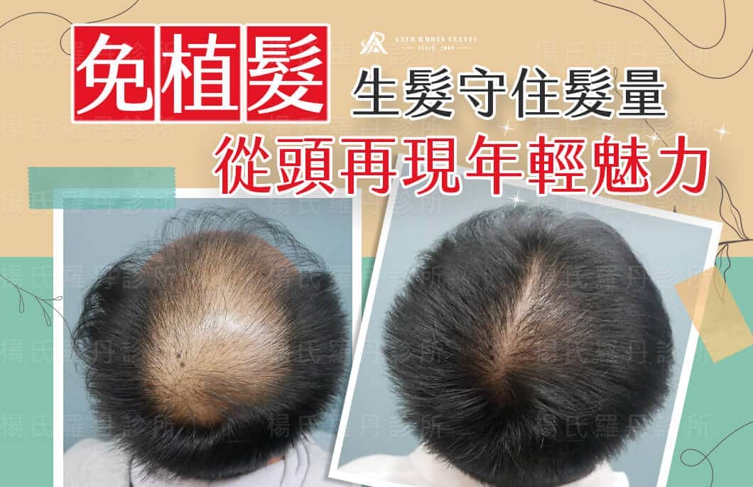 【複合式生髮】生髮守住髮量，免植髮從頭再現年輕魅力
