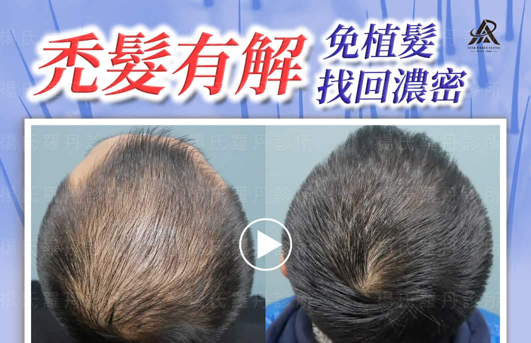 【複合式生髮】禿髮有解，免植髮找回濃密的秘密在這裡