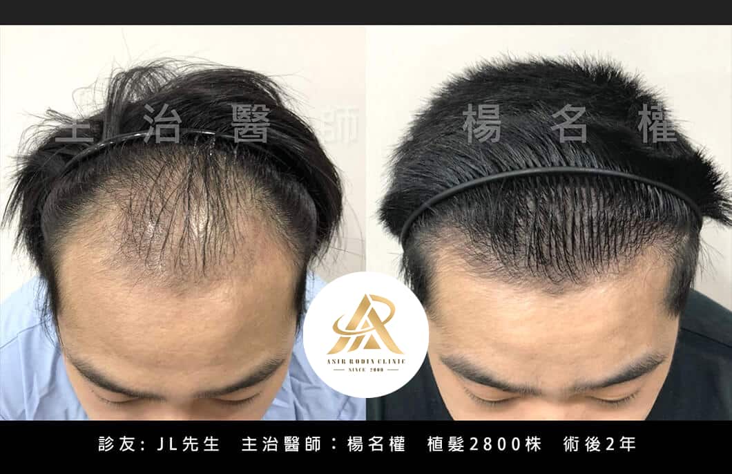 【植髮】甩開多年禿頭和老態，給自己的一份茂密禮物!