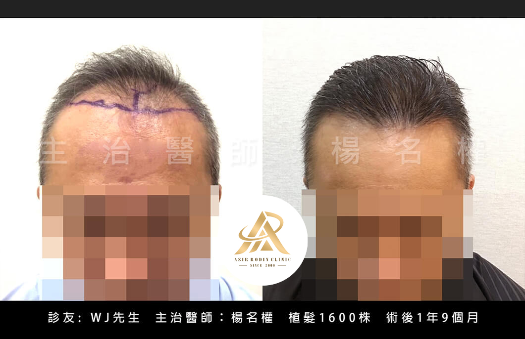 【植髮】你擔憂的髮際線問題，我們來幫忙「植」到最好