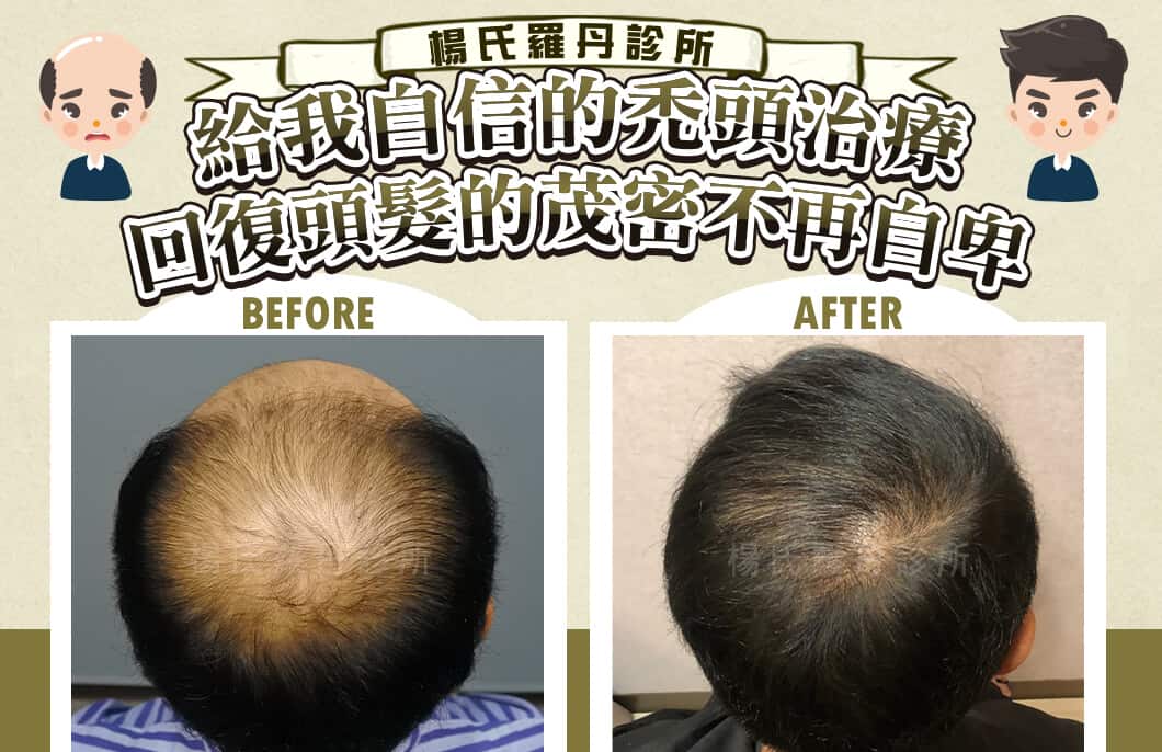 【植髮】給我自信的禿頭治療，回復頭髮的茂密不再自卑