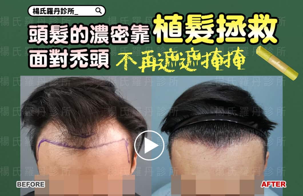 【植髮】頭髮的濃密靠植髮拯救，面對禿頭不再遮遮掩掩