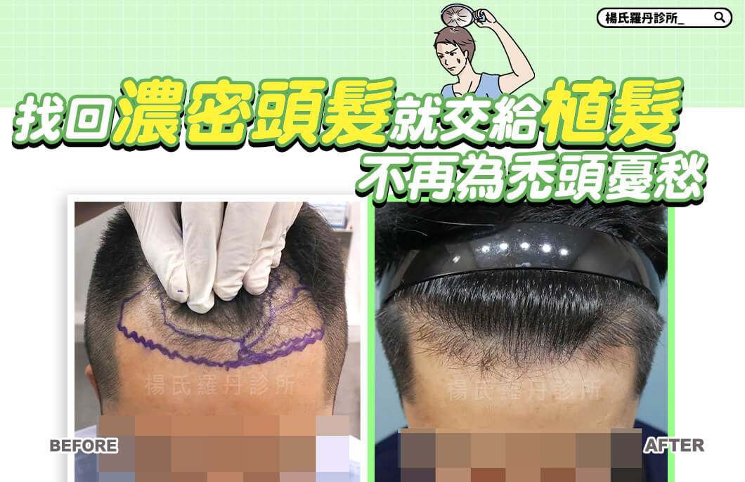 【植髮】論找回頭髮的濃密就交給植髮，不再為禿頭憂愁