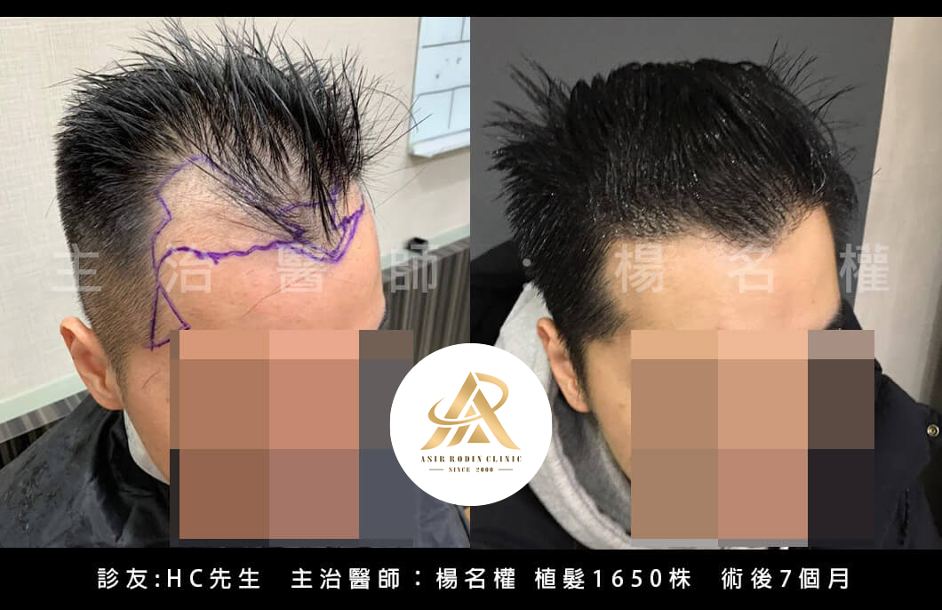 【植髮】從「頭」開始改變，解決落髮找回我的年輕濃密