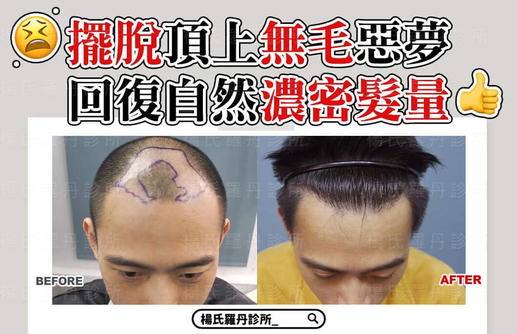 【植髮】擺脫頂上無毛掉髮惡夢，術後回復自然濃密髮量