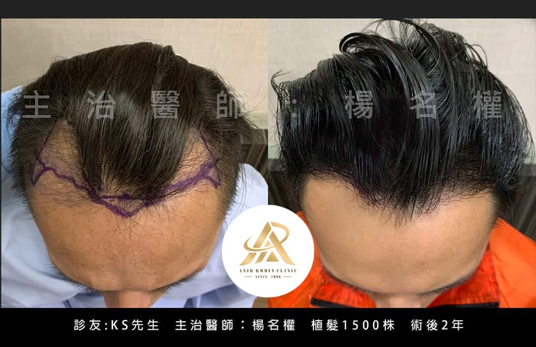 【植髮】讓髮際線勇敢向前，重現完整茂密髮量更加自信