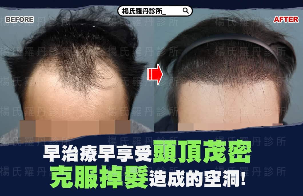 【植髮】早治療早享受頭頂茂密，克服掉髮造成的空洞!