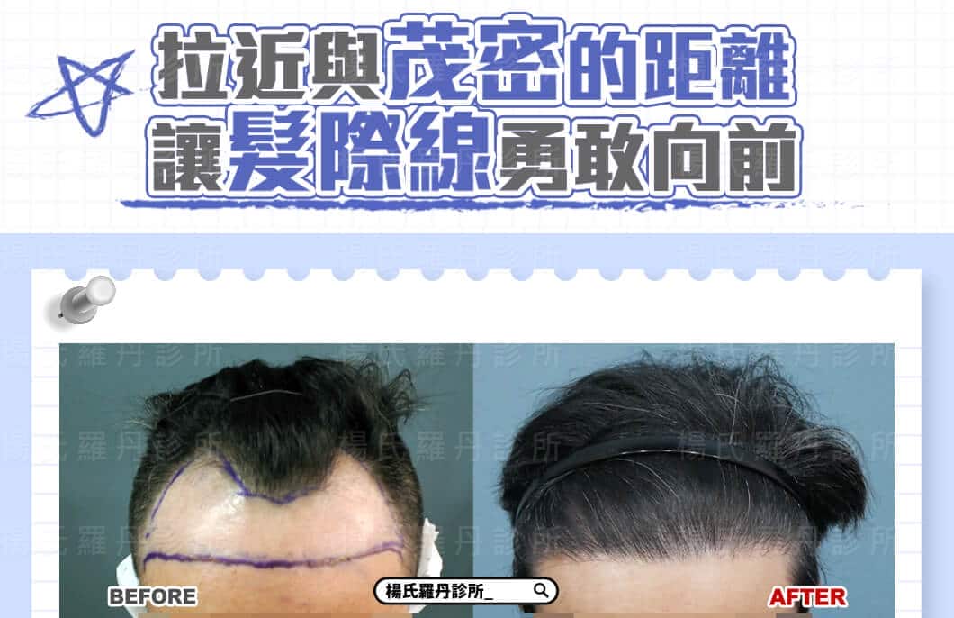 【植髮】拉近與茂密的距離，讓髮際線勇敢向前回復年輕