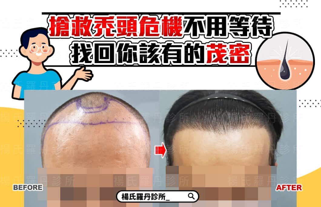 【植髮】搶救禿頭危機不用等待，術後找回你該有的茂密