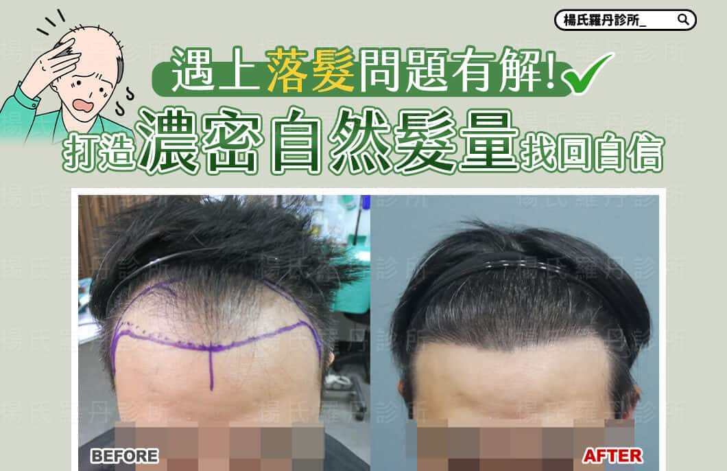 【植髮】遇上落髮問題有解，打造濃密自然髮量找回自信