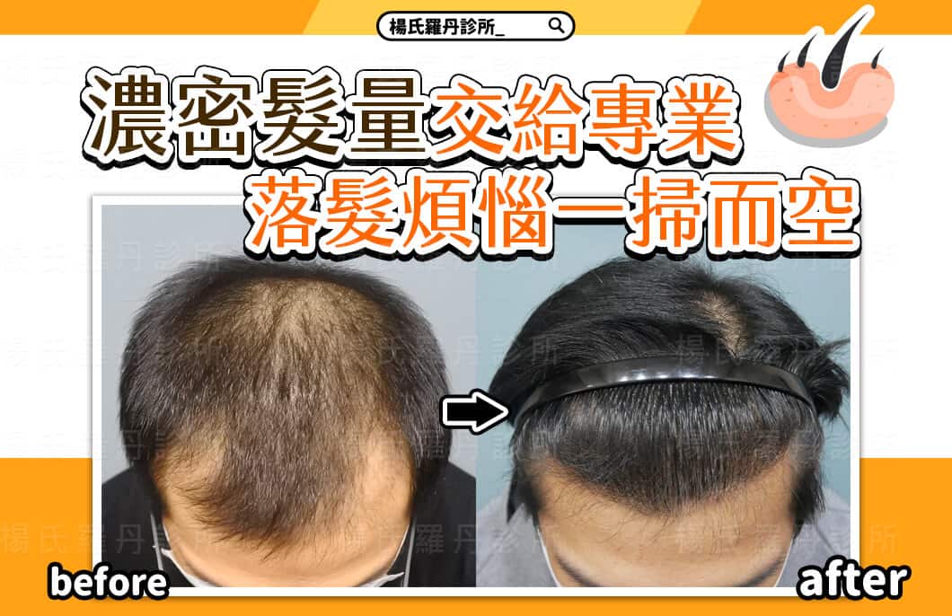 【植髮】實現濃密的髮量交給專業，將落髮煩惱一掃而空