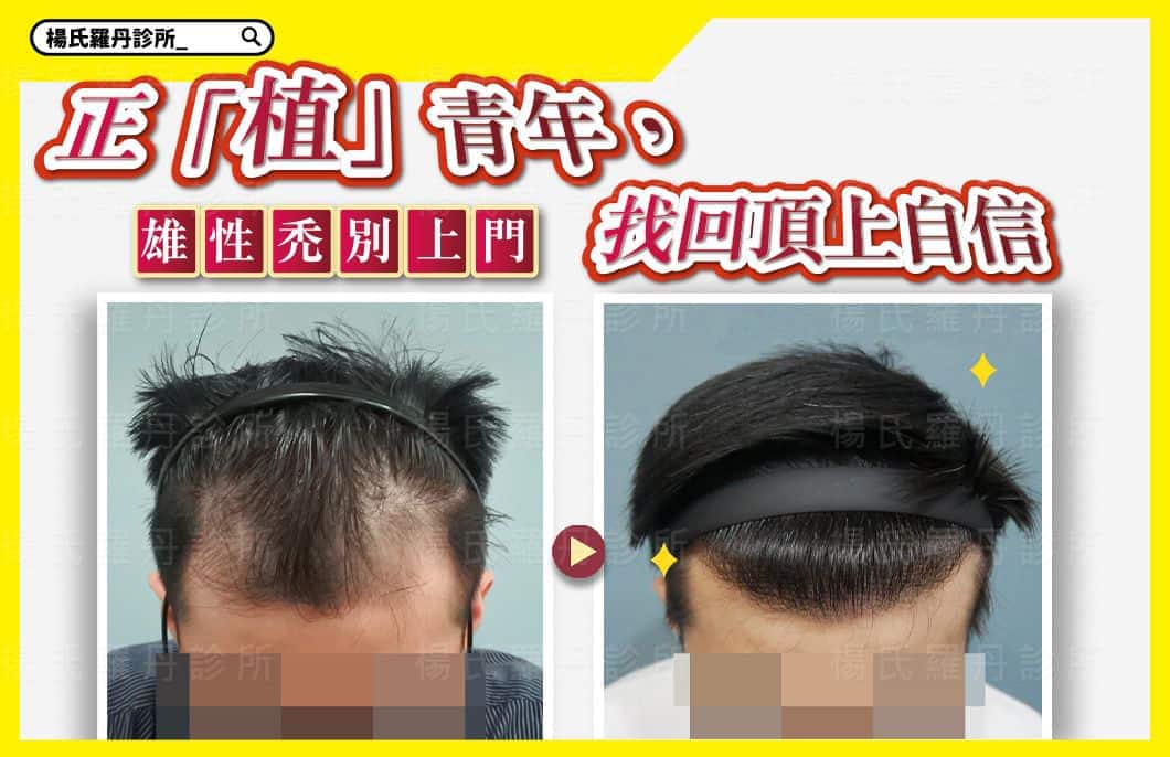 【植髮】正「植」青年，找回頂上自信，雄性禿別上門!