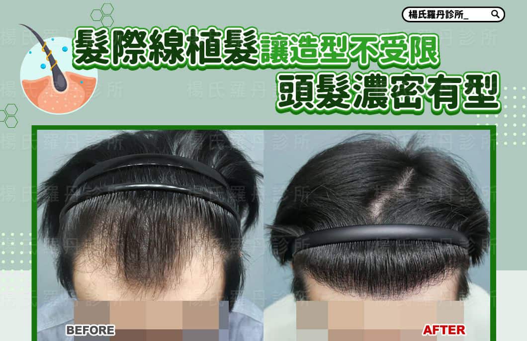 【植髮】髮際線植髮讓造型不受限，回歸頭髮的濃密有型