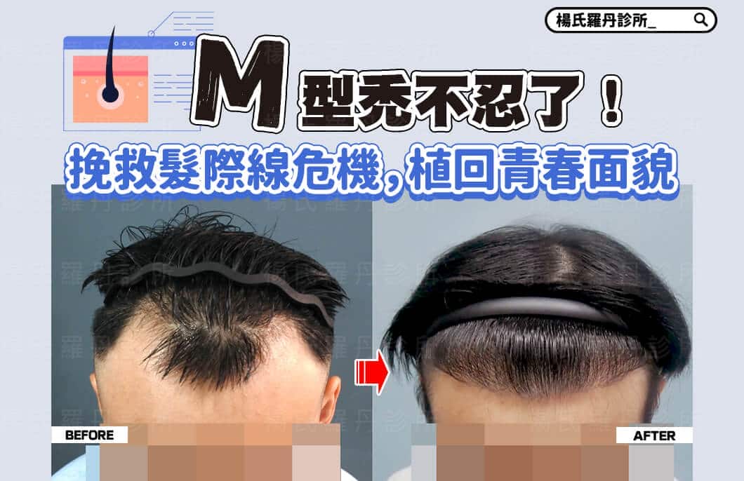 【植髮】M型禿不忍了！挽救髮際線危機，植回青春面貌