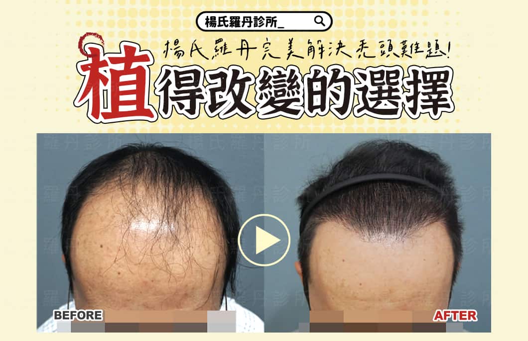 【植髮】植得改變的選擇，楊氏羅丹完美解決禿頭難題！
