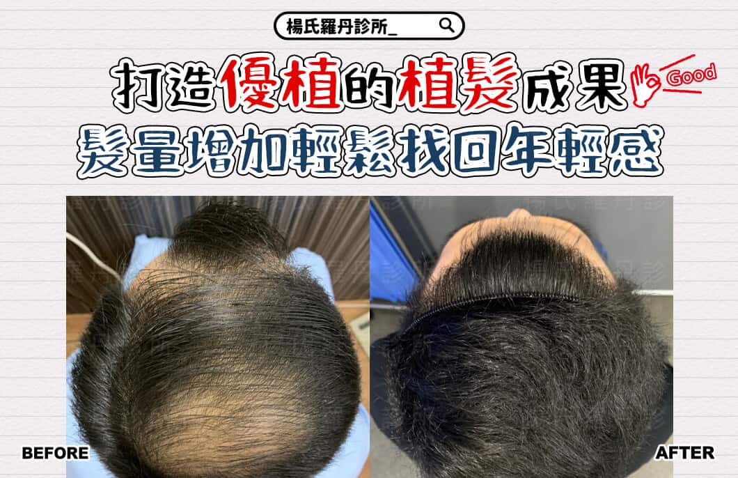 【植髮】打造優植的植髮成果，髮量增加輕鬆找回年輕感