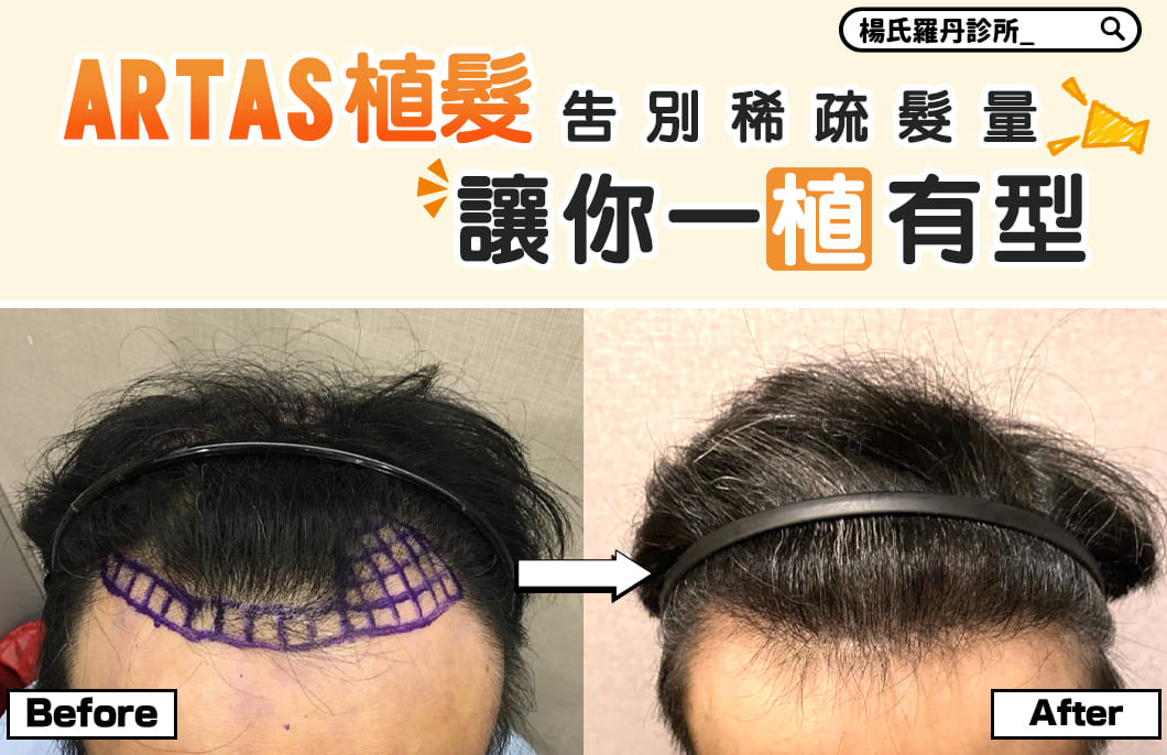 【植髮】ARTAS植髮告別稀疏髮量，讓你一「植」有型
