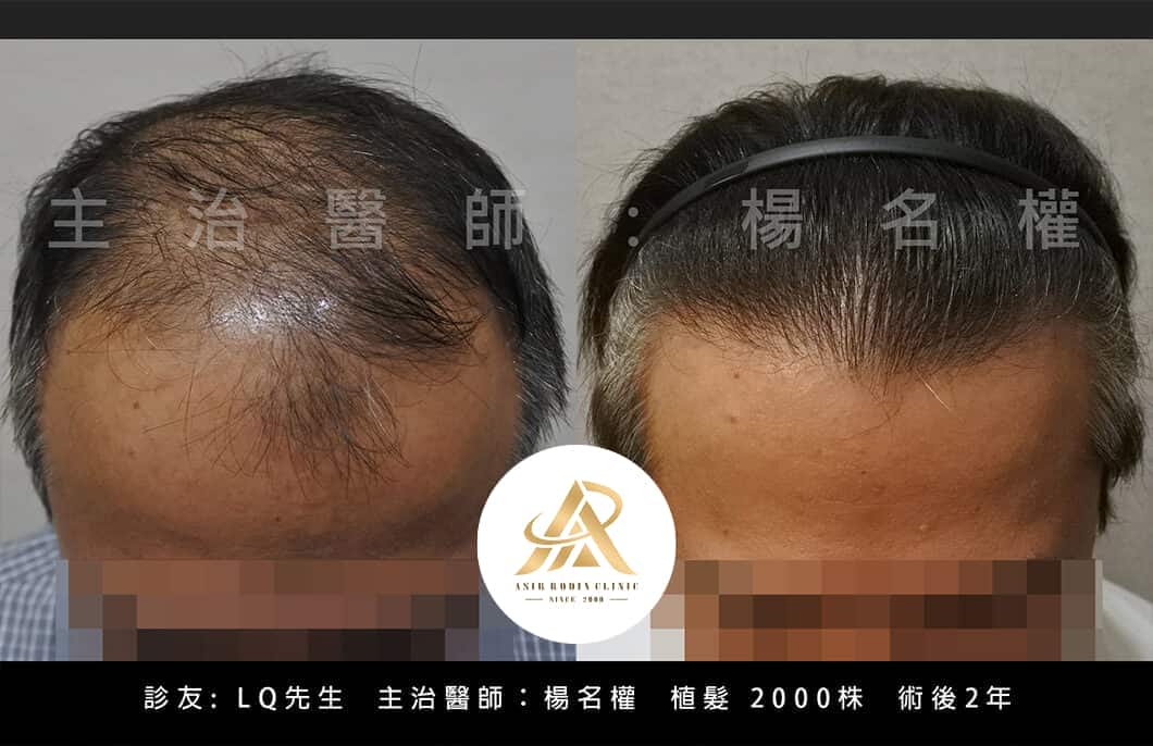 【植髮】植髮告別禿髮，你「植」得擁有這樣的濃密改變
