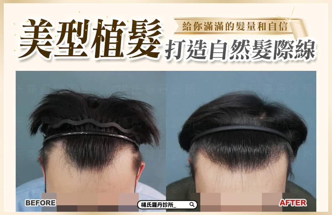 【植髮】美型植髮打造自然髮際線，給你滿滿的髮量和自信