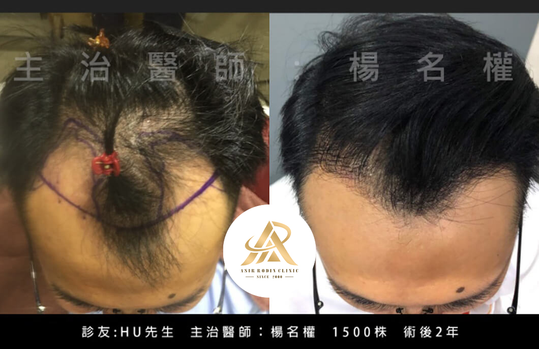 【植髮】搶救髮際線危機，專業的植髮手術替你完美解決